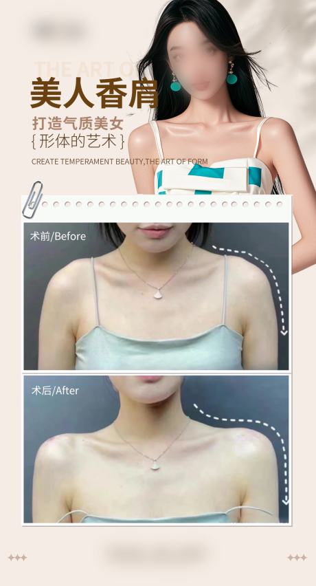 源文件下载【医美美人肩案例海报】编号：58750030113772249