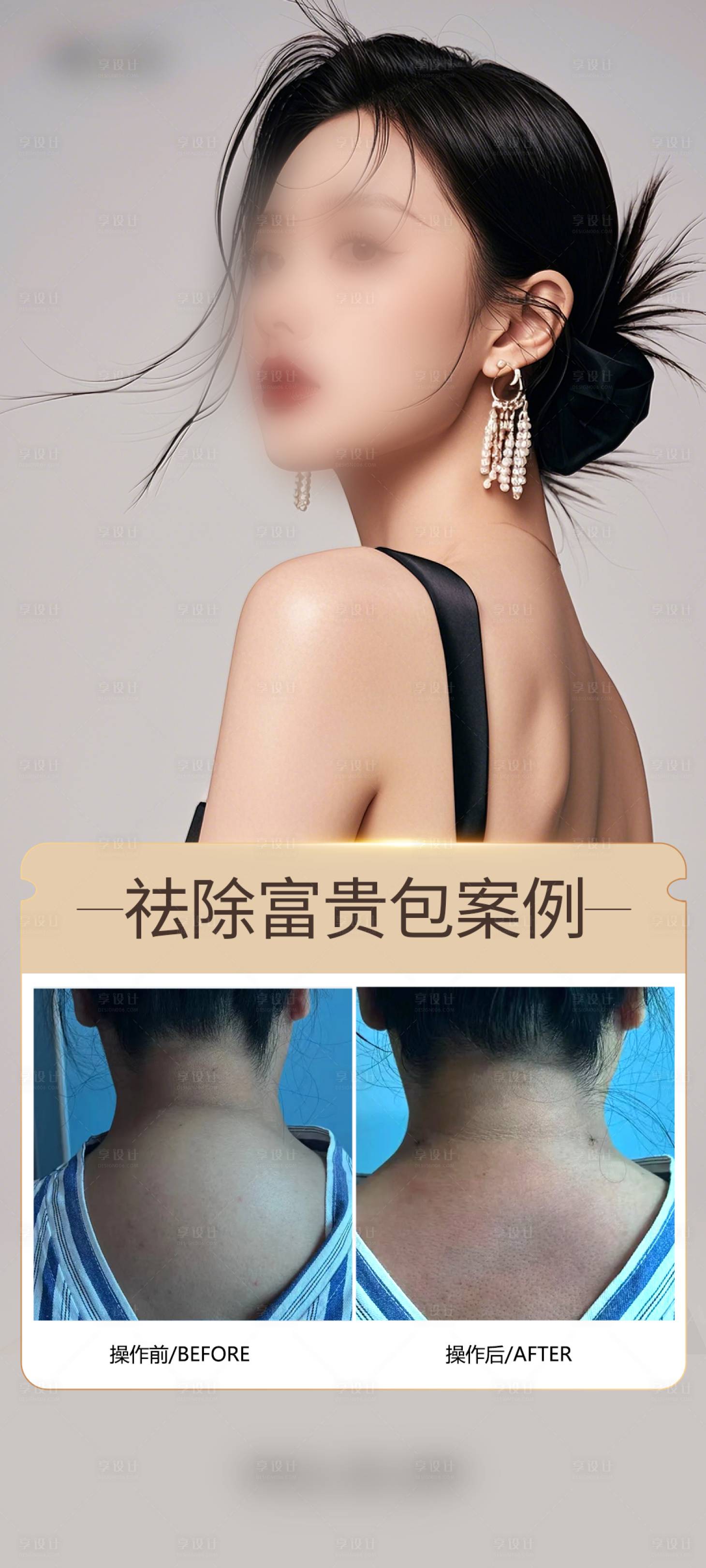 源文件下載【享設(shè)計(jì)】搜索編號(hào)：84670030446345697【醫(yī)美富貴包案例海報(bào)】
