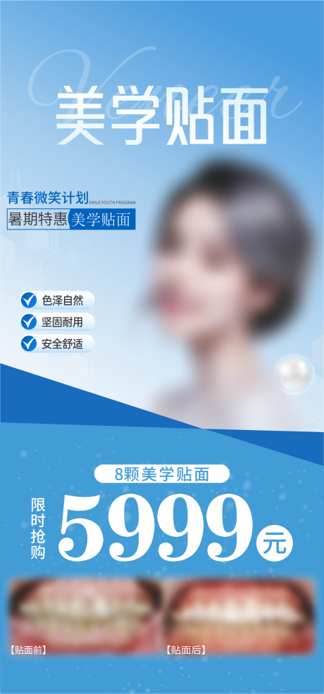 美学贴面