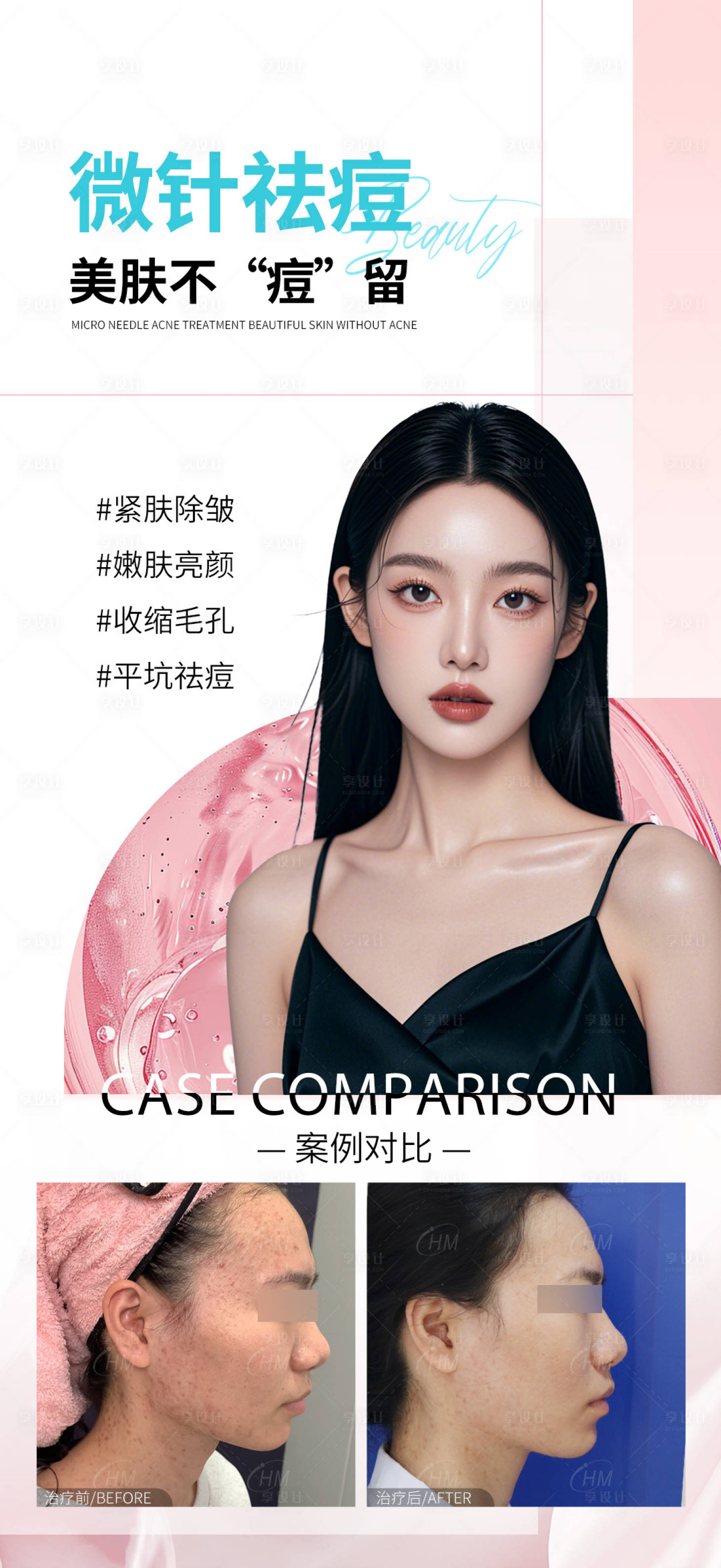 源文件下载【享设计】搜索编号：61950029917123447【微针祛痘医美海报】