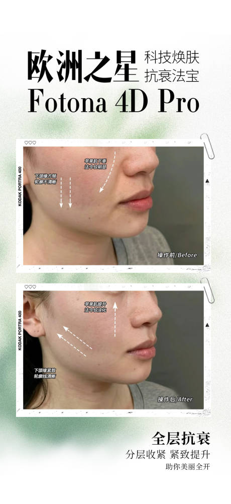 源文件下载【fotona4D案例对比】编号：99840030085607661