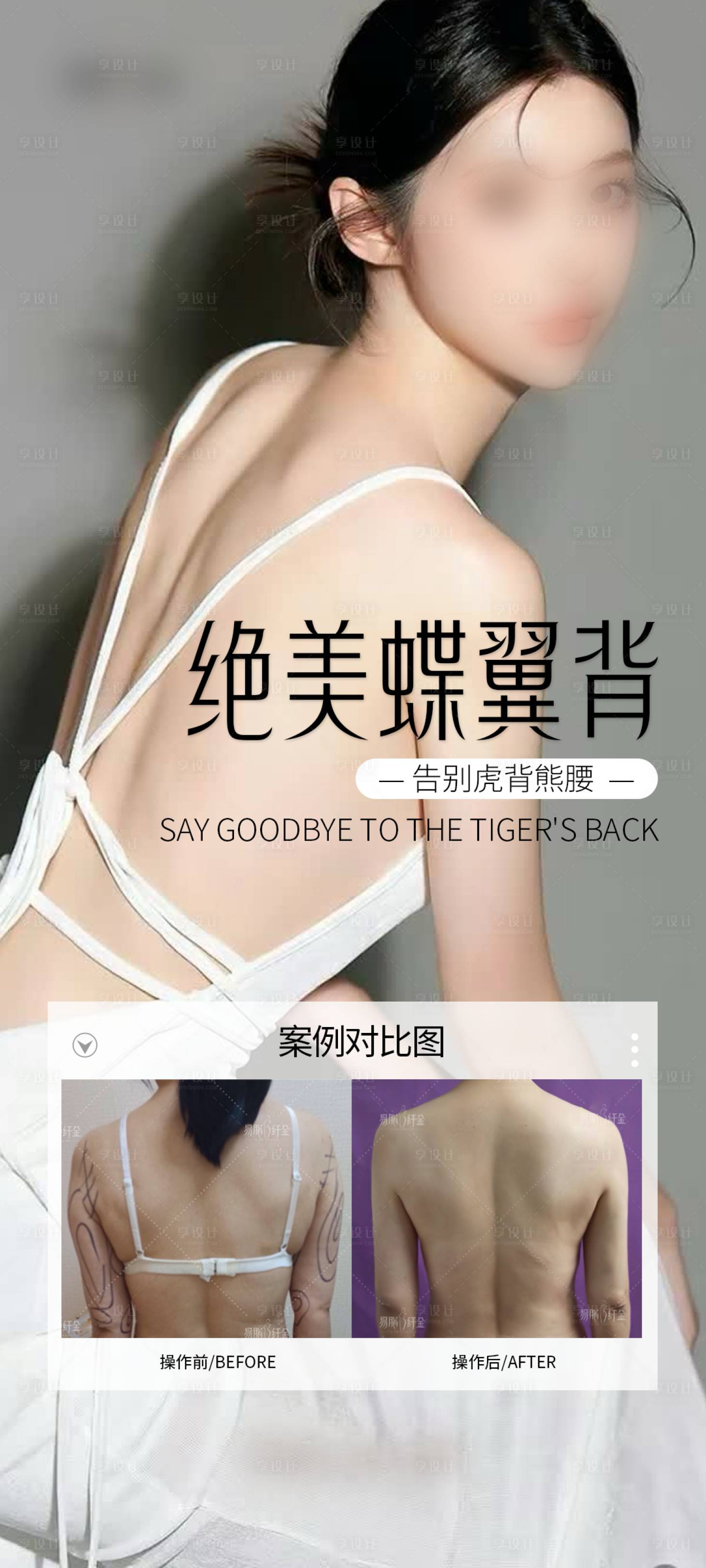 源文件下载【医美美背案例海报】编号：29400029954911555
