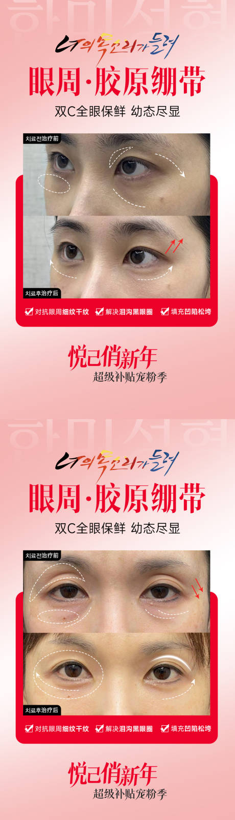 医美眼周胶原绷带案例海报