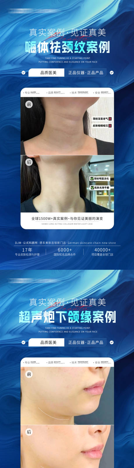 源文件下載【醫美藍色案例系列海報】編號：86150030265965251