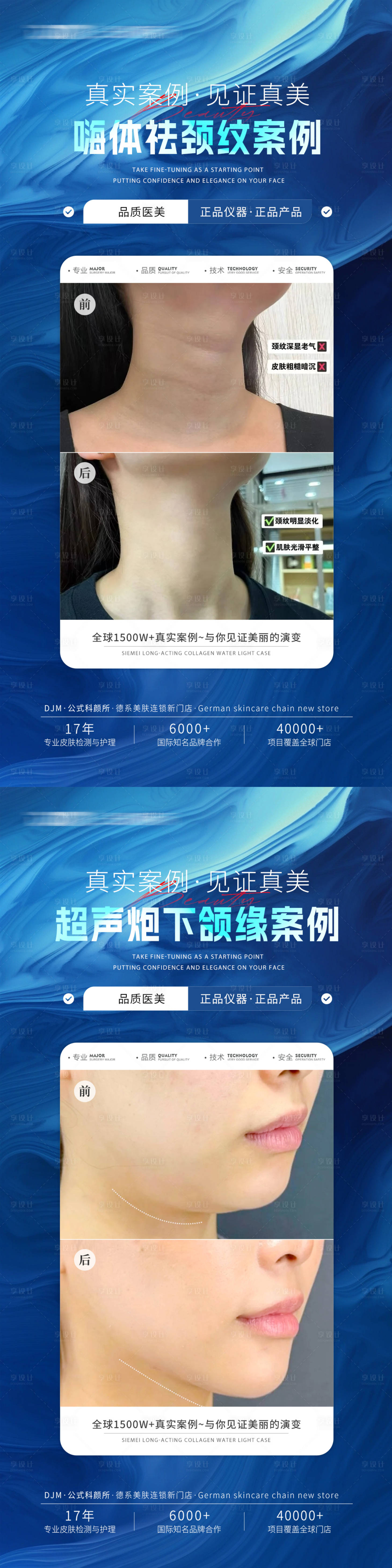 源文件下載【醫美藍色案例系列海報】編號：86150030265965251