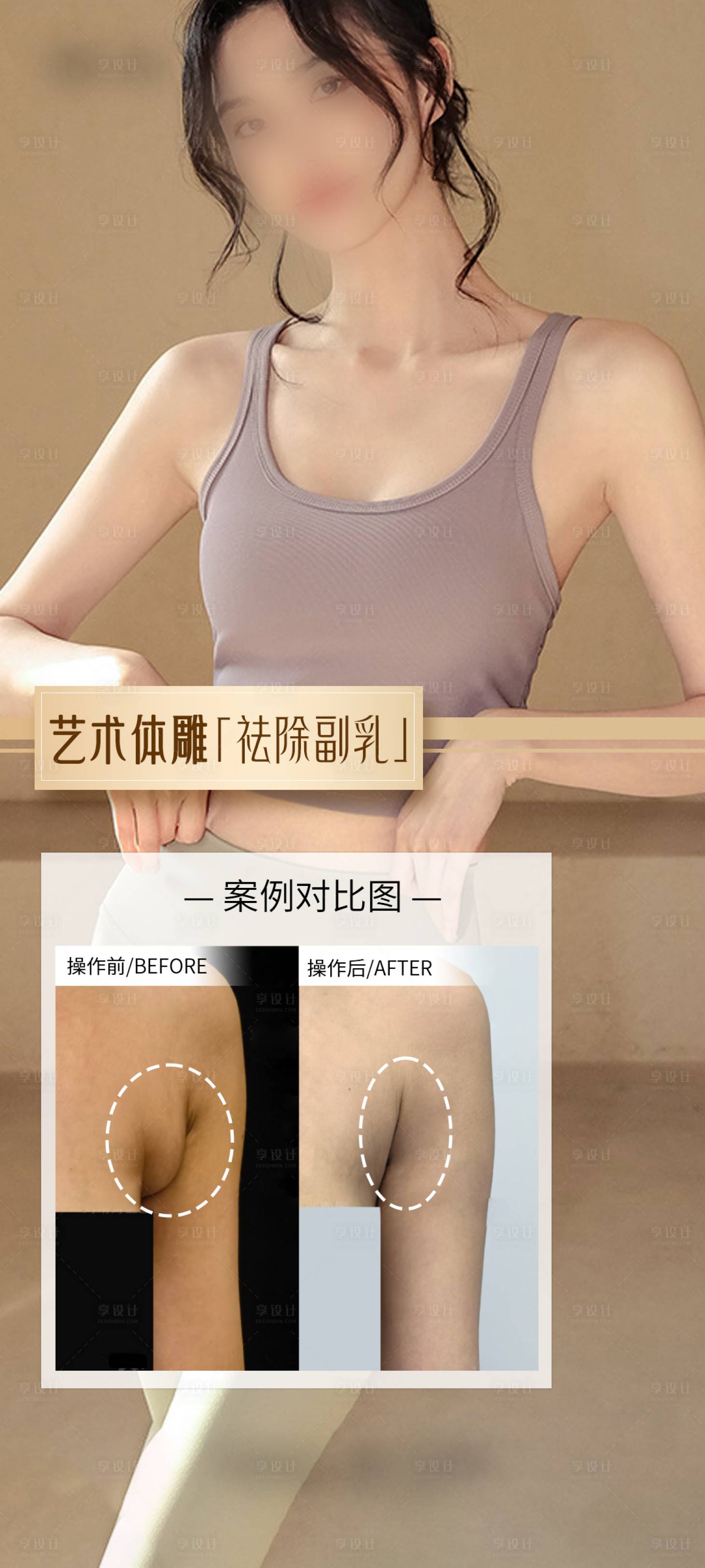 源文件下载【医美祛除副乳案例海报】编号：98410029954981603