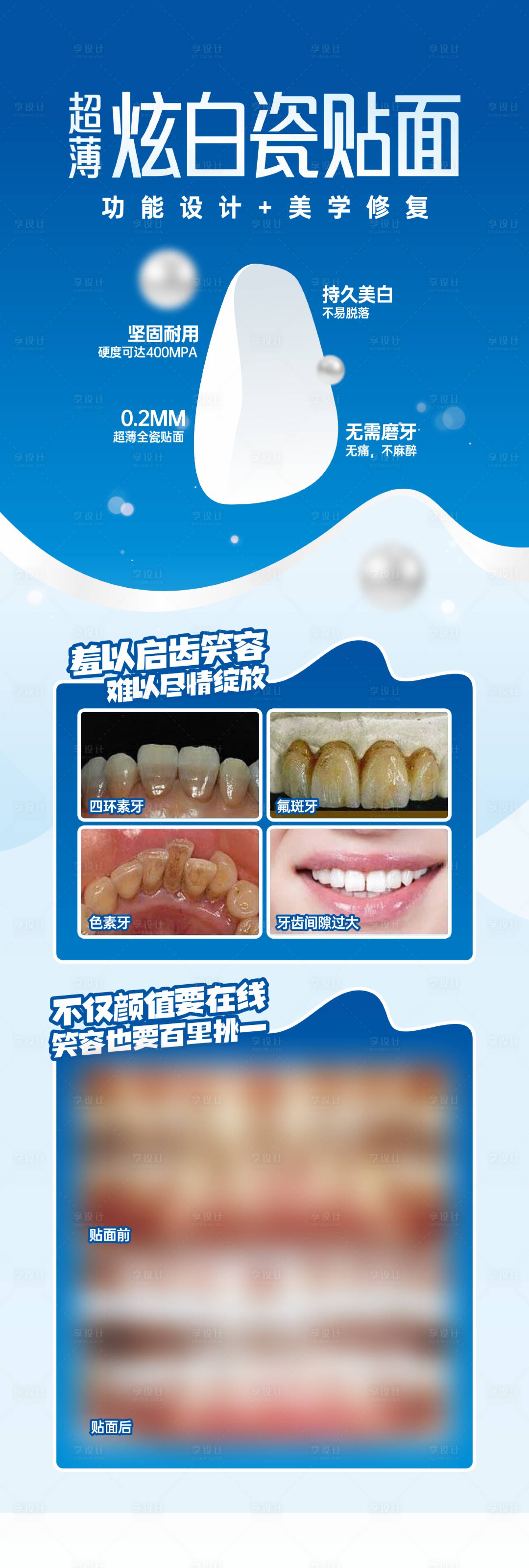 源文件下载【享设计】搜索编号：32610029916662544【超薄瓷贴面】