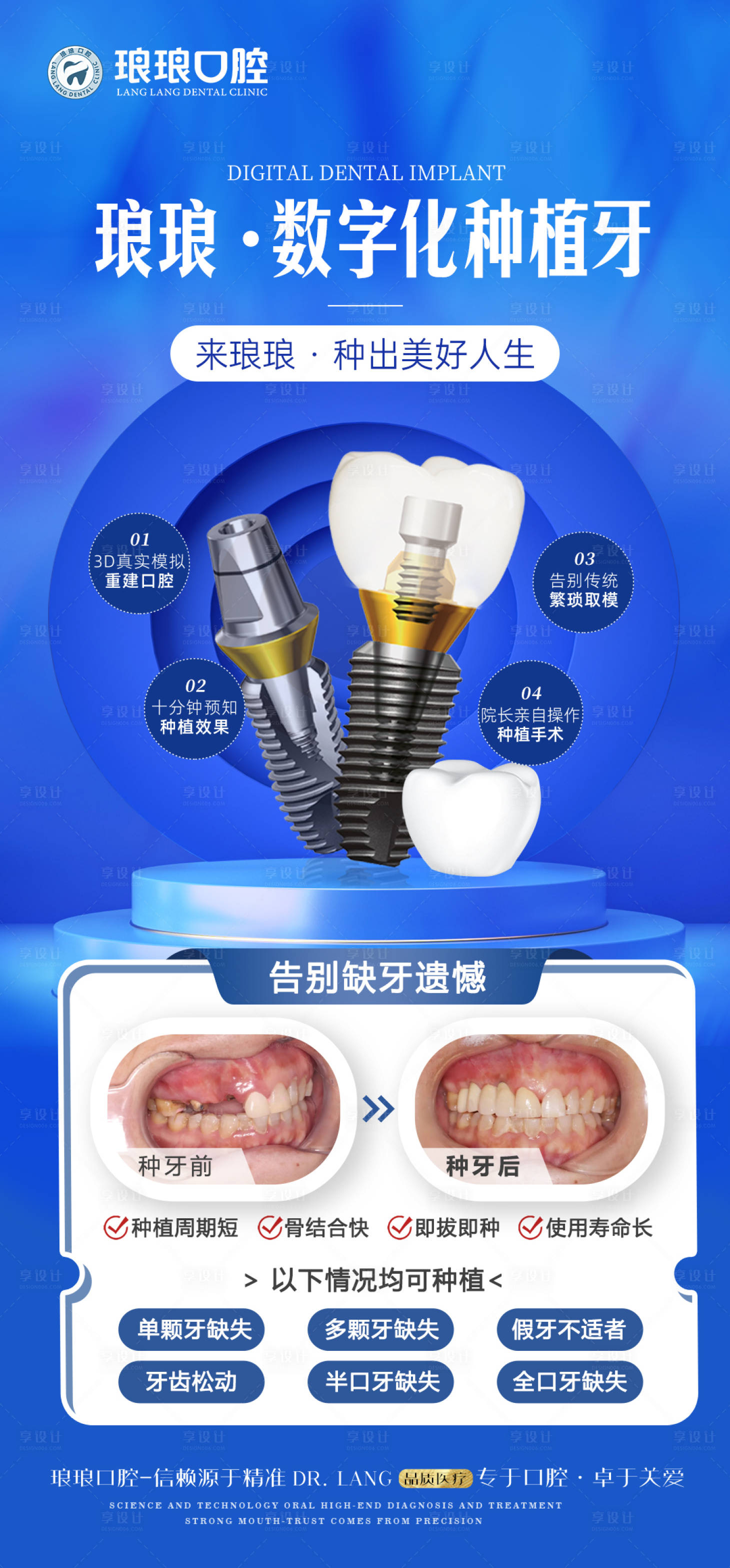 源文件下载【享设计】搜索编号：56880029959934600【数字化种植牙海报】