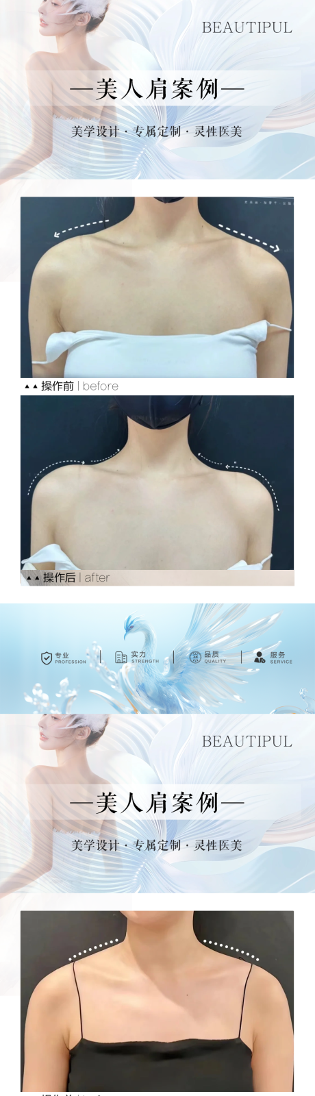 源文件下載【享設計】搜索編號：55690030476265346【整形美人肩案例對比海報】