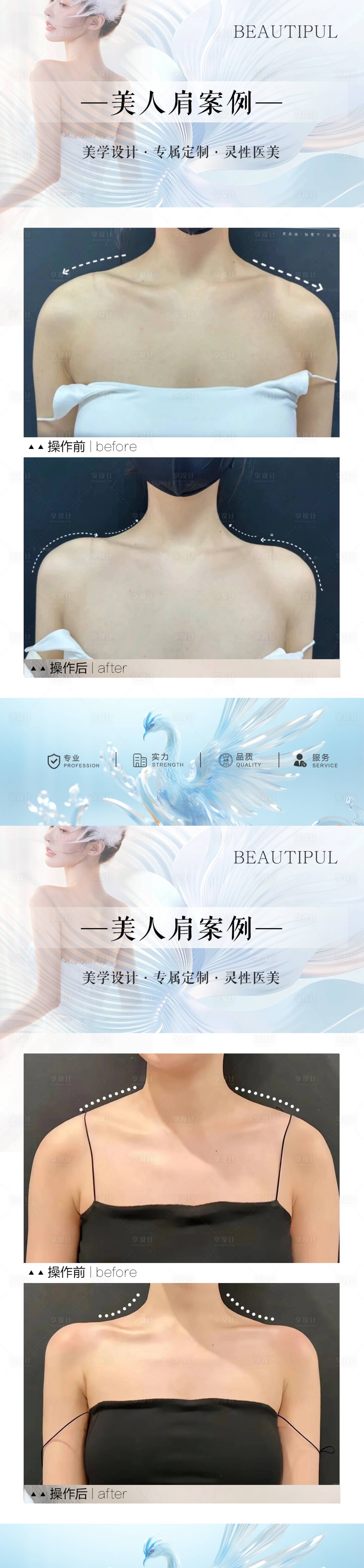 源文件下載【享設計】搜索編號：55690030476265346【整形美人肩案例對比海報】