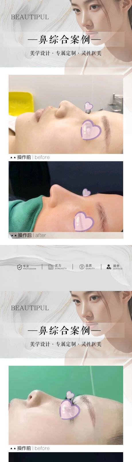 源文件下載【享設計】搜索編號：82180030436486075【整形鼻綜合案例宣傳海報】