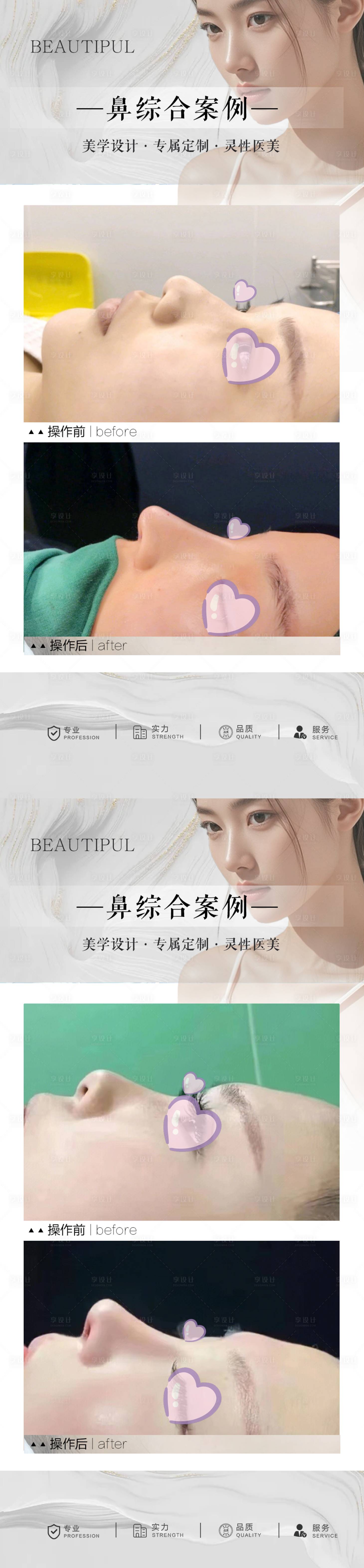 源文件下載【享設計】搜索編號：82180030436486075【整形鼻綜合案例宣傳海報】