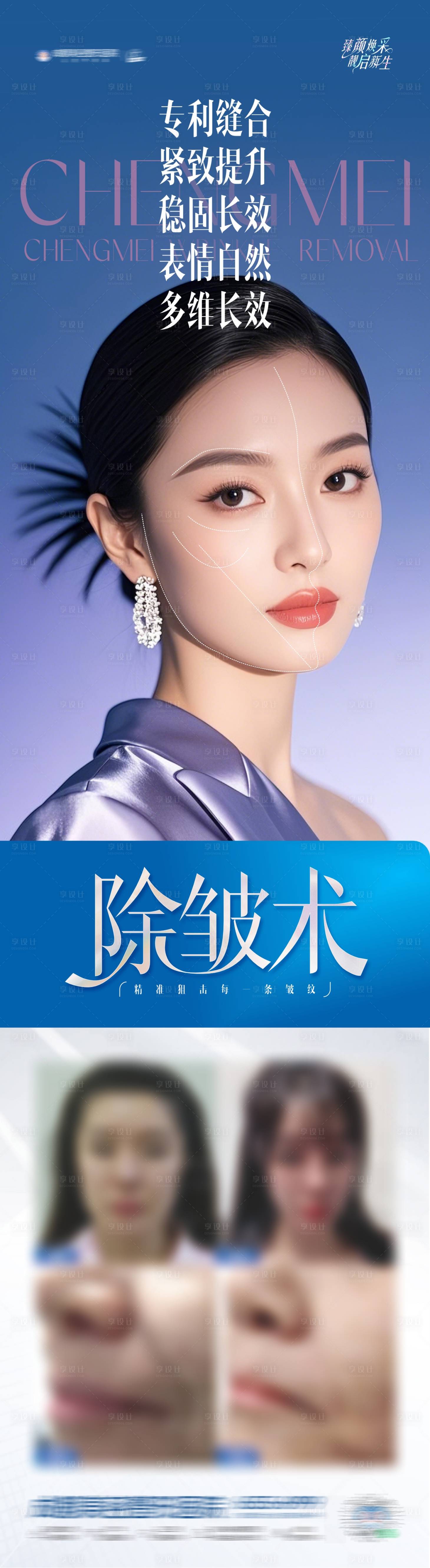 源文件下載【醫(yī)美除皺術(shù)案例長(zhǎng)圖創(chuàng)意海報(bào)】編號(hào)：40210029884407078
