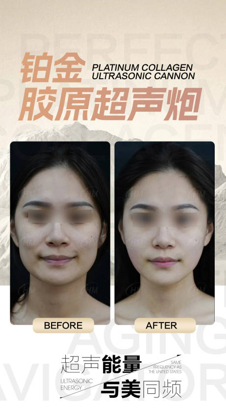 源文件下載【鉑金超聲炮案例宣傳海報】編號：64860030011078310