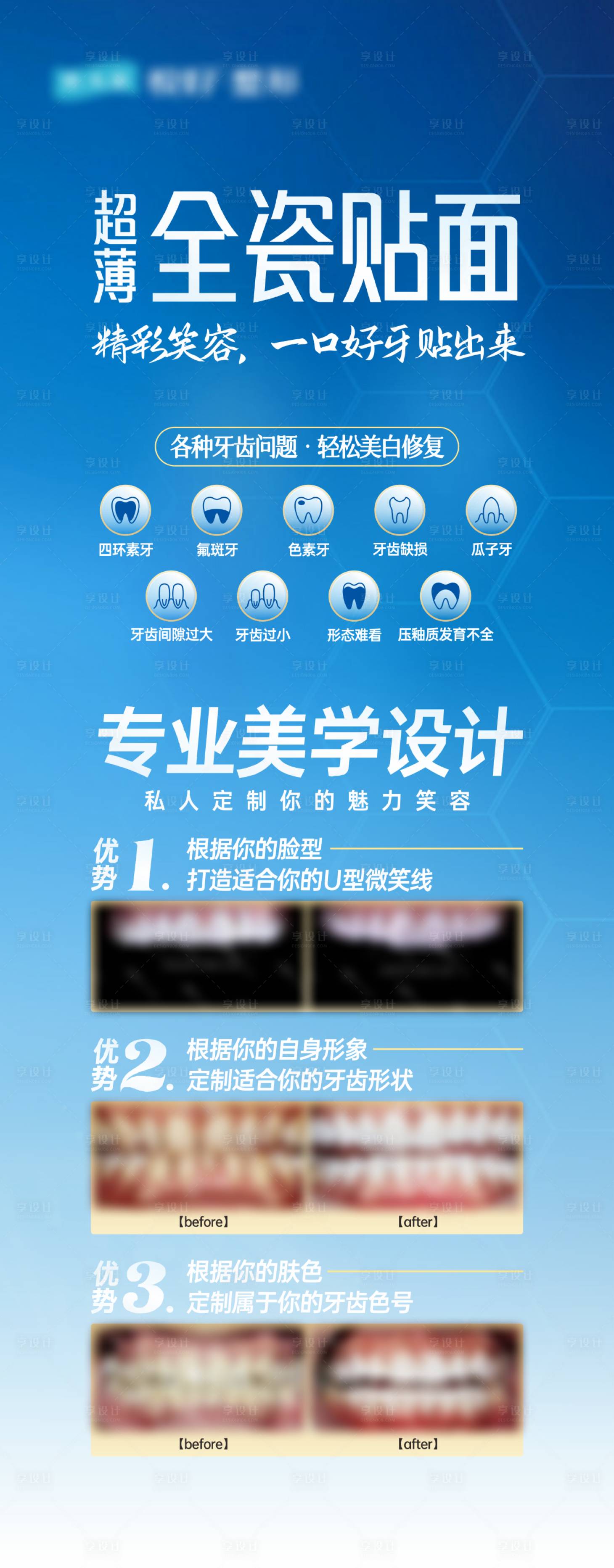 源文件下載【全瓷貼面口腔長圖】編號：50810029914082822