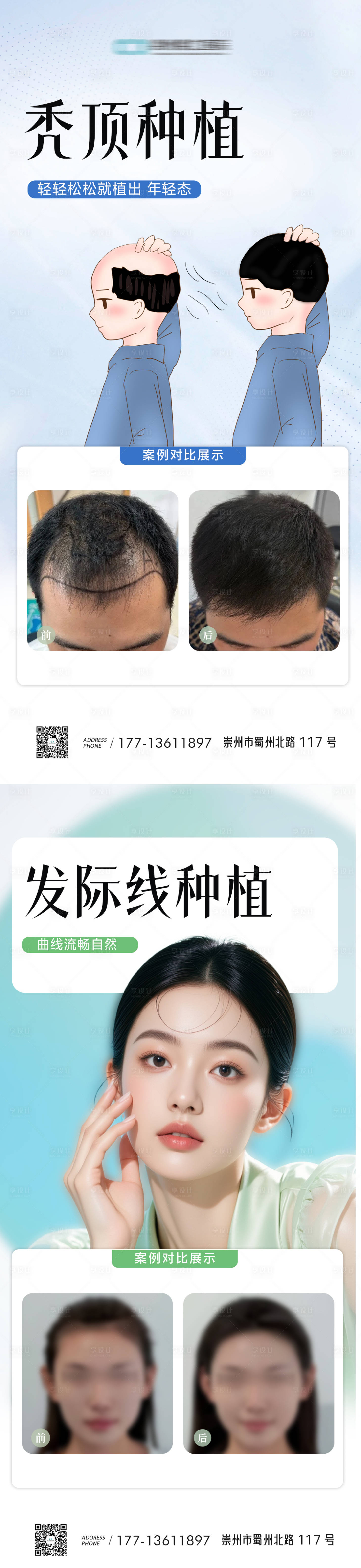 源文件下载【享设计】搜索编号：89570030355135346【发际线秃顶植发案例海报】