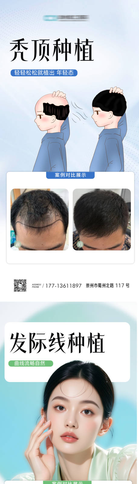 发际线秃顶植发案例海报