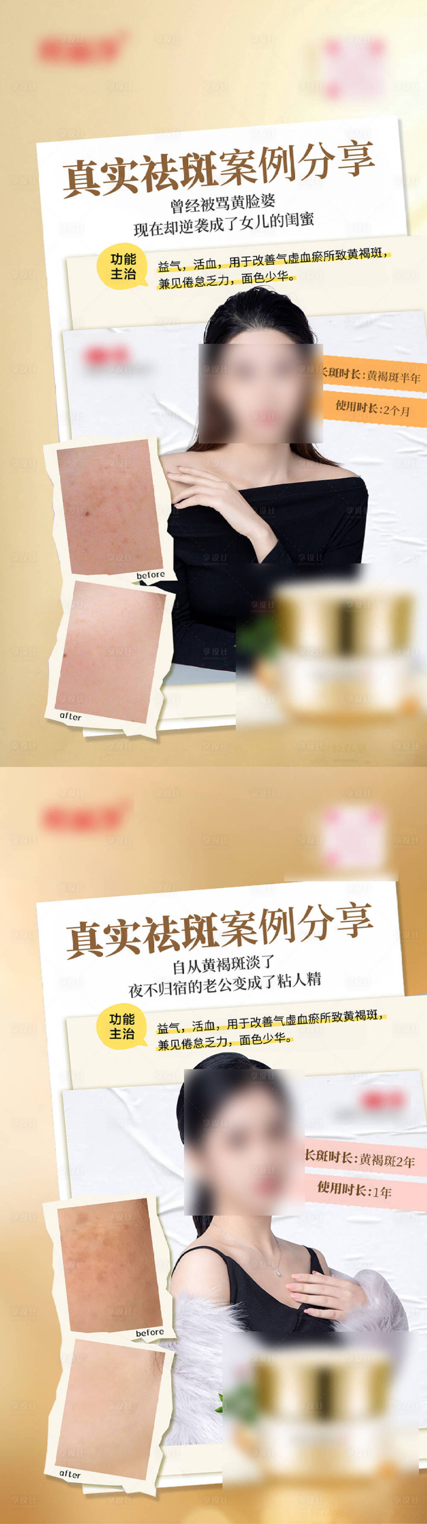 源文件下載【享設計】搜索編號：39300030102685091【祛斑海報】