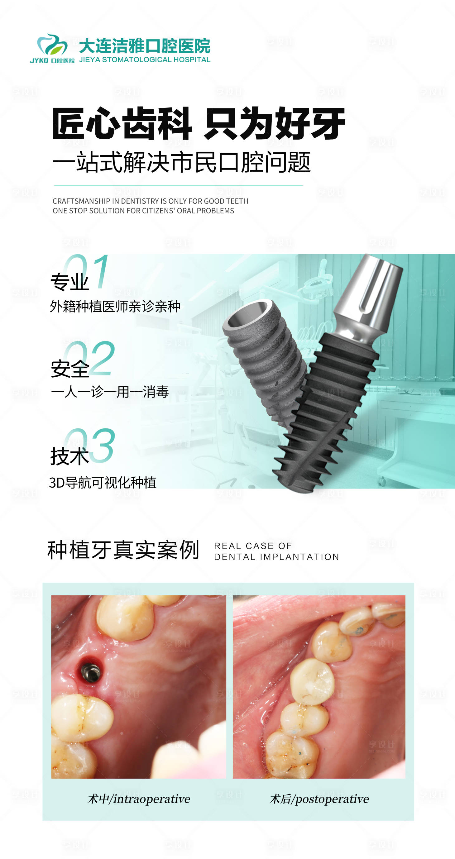 源文件下載【享設計】搜索編號：19040030329362302【口腔種植牙案例對比海報】