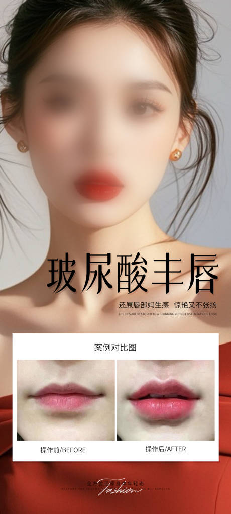 源文件下载【医美玻尿酸丰唇案例海报】编号：53530030701165969