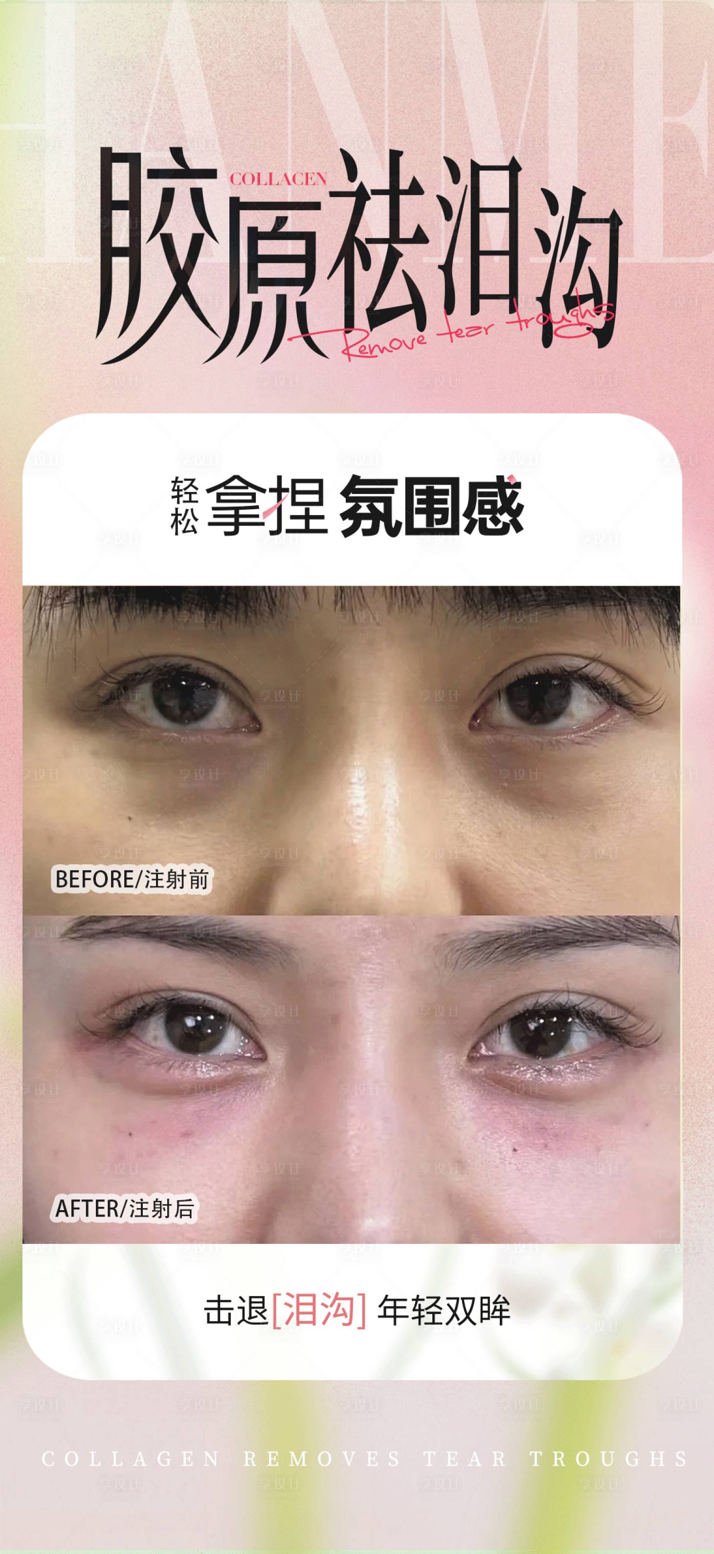 源文件下载【享设计】搜索编号：99470030552103945【胶原祛泪沟】