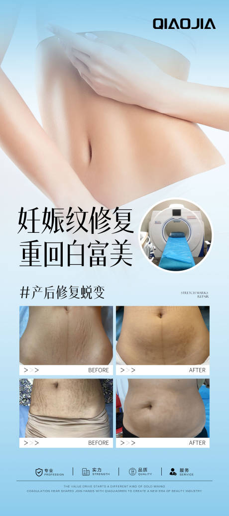 妊娠纹案例对比