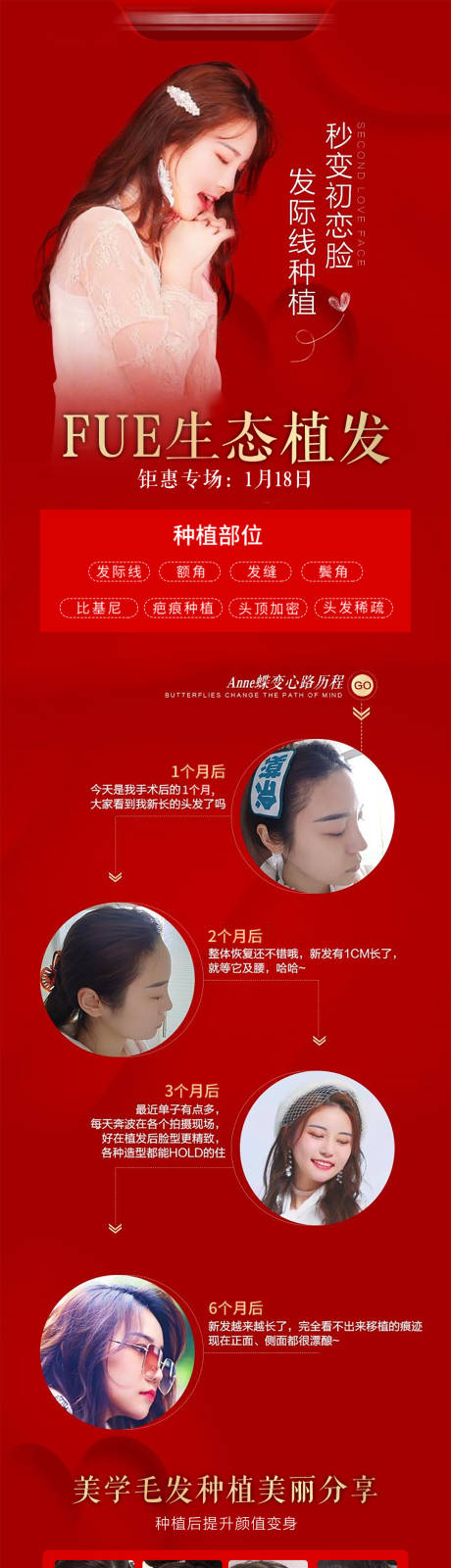 源文件下載【植發推廣海報】編號：23690030953045935
