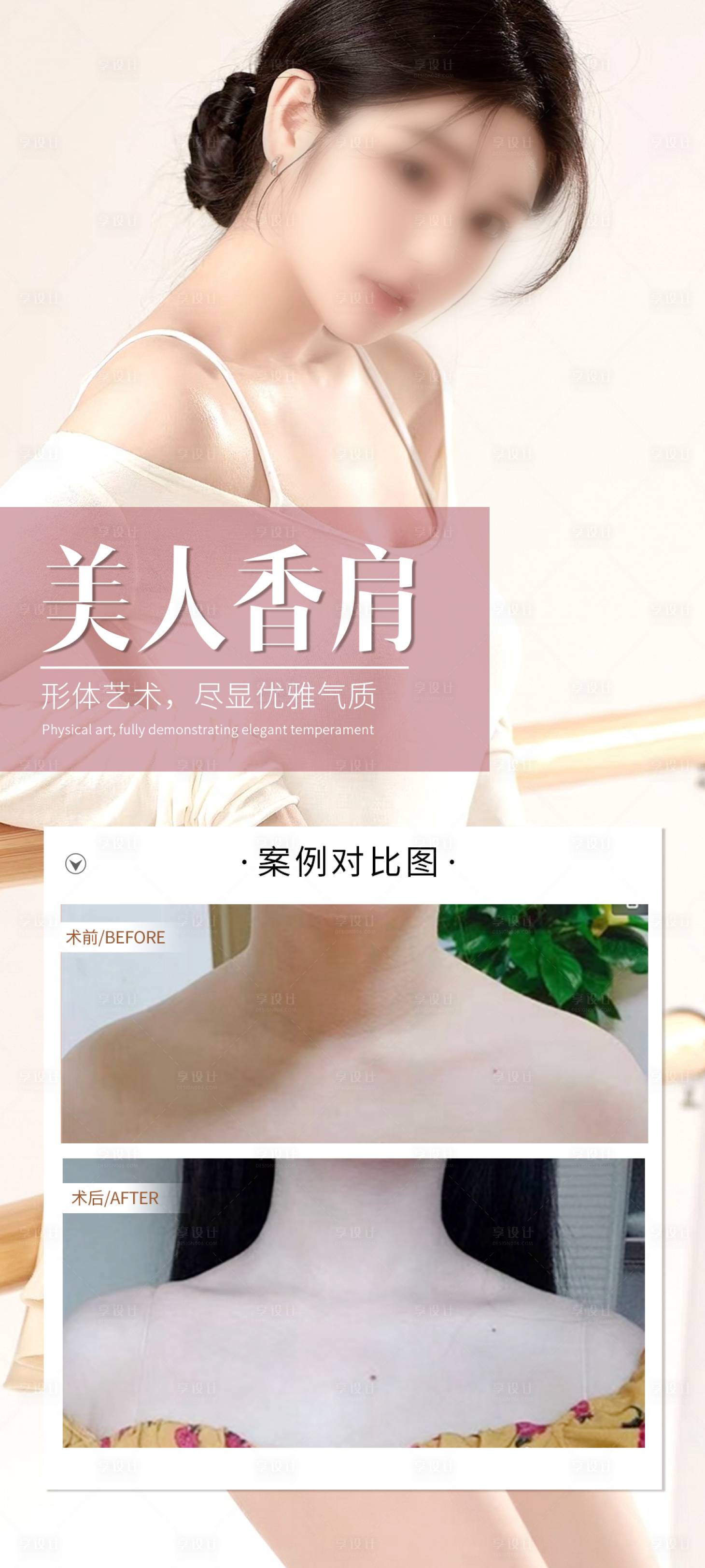 源文件下載【享設(shè)計】搜索編號：42070030876754312【醫(yī)美美人肩案例海報】