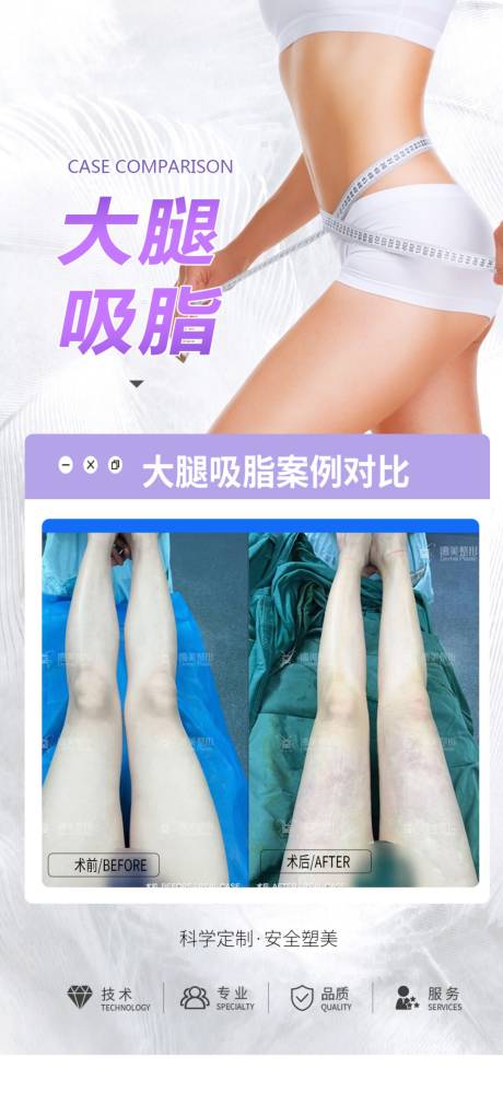 大腿吸脂海报