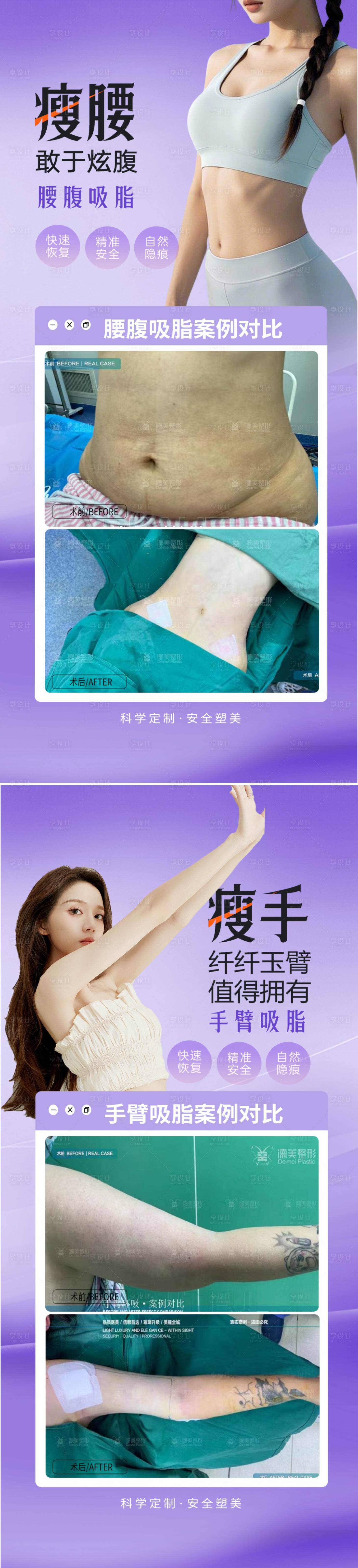 源文件下載【享設計】搜索編號：44460030822015676【腰腹手臂吸脂案例】