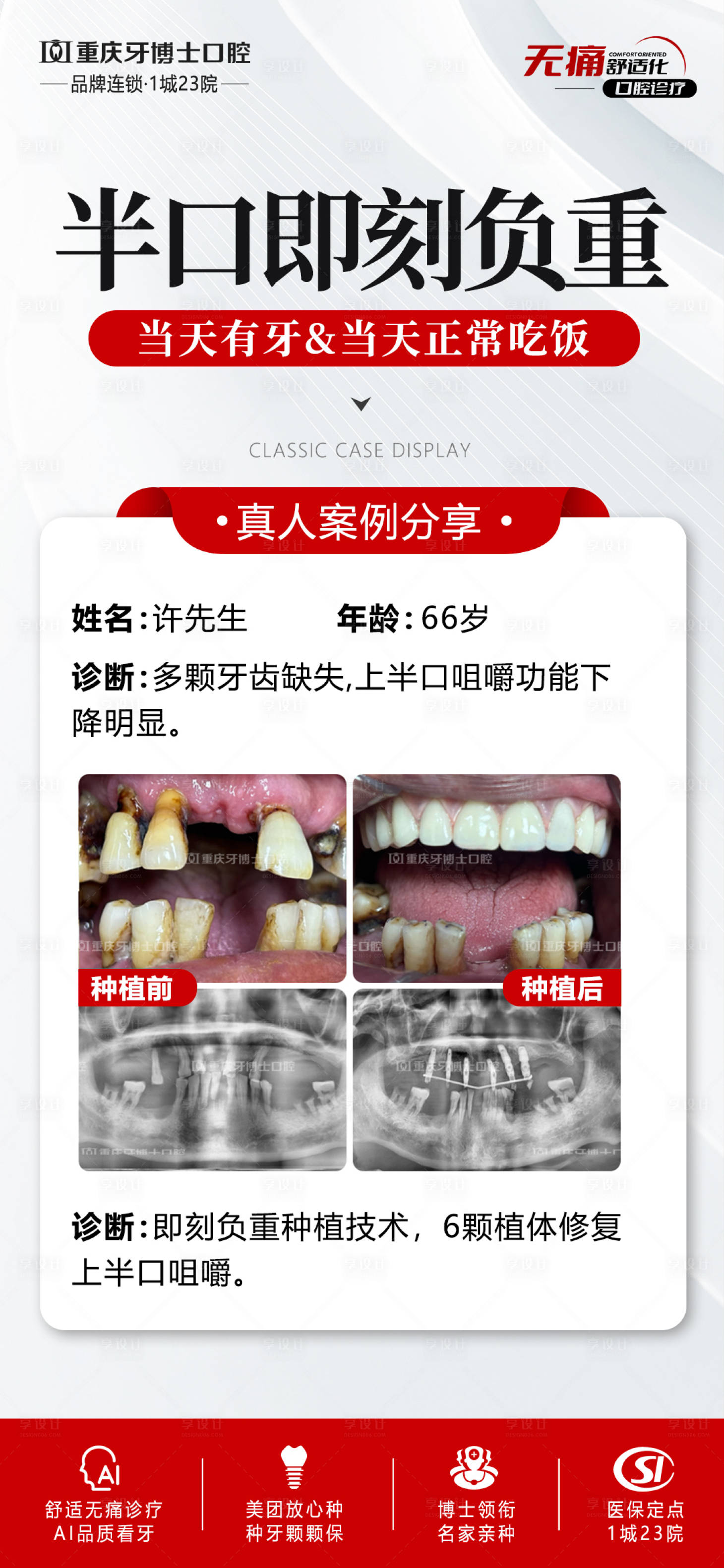 源文件下载【享设计】搜索编号：53070030831987089【口腔种植牙案例】