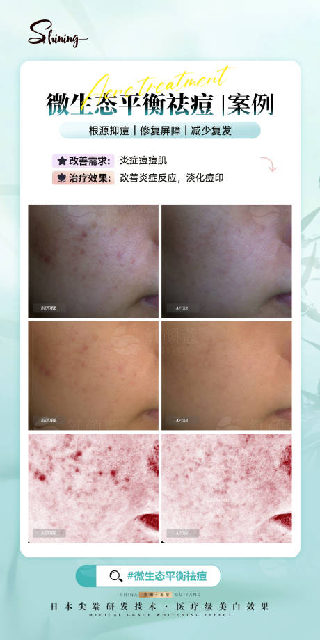 源文件下载【医美祛痘案例】编号：83440030578293580