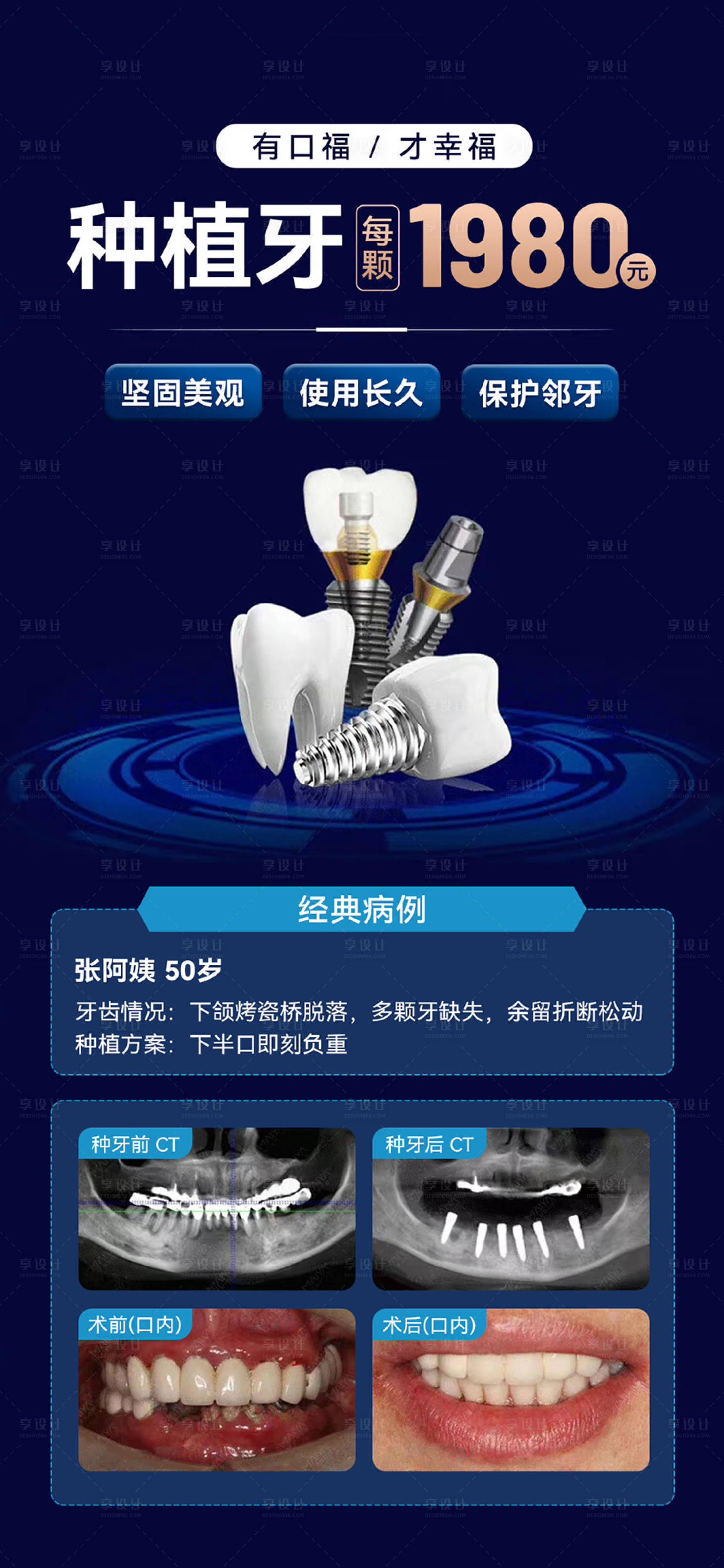 源文件下載【口腔種植牙宣傳案例海報】編號：39120030960535461
