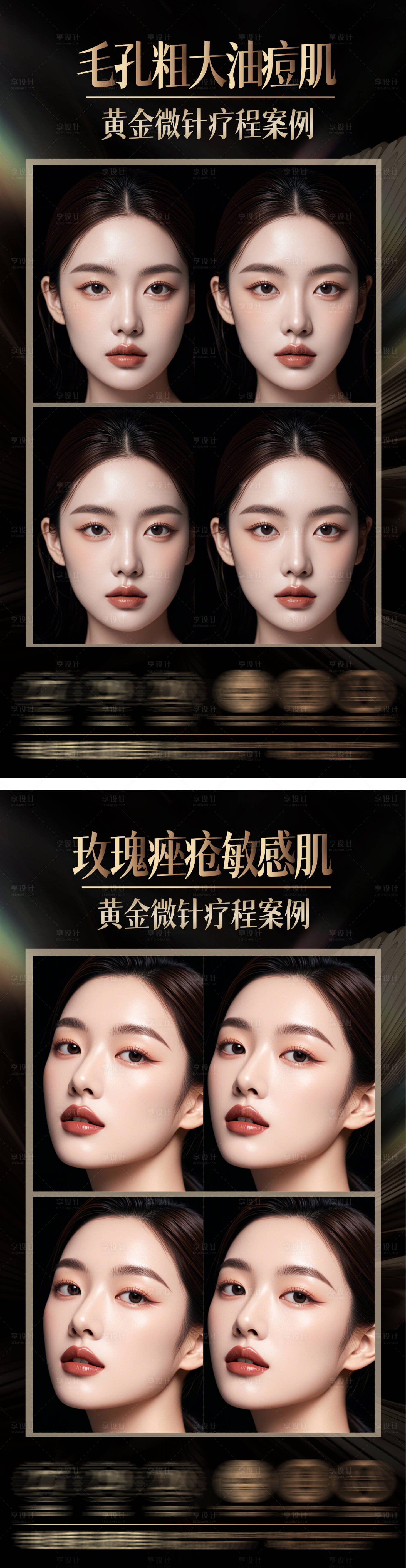 源文件下載【黃金微針 】編號：84270030832631967