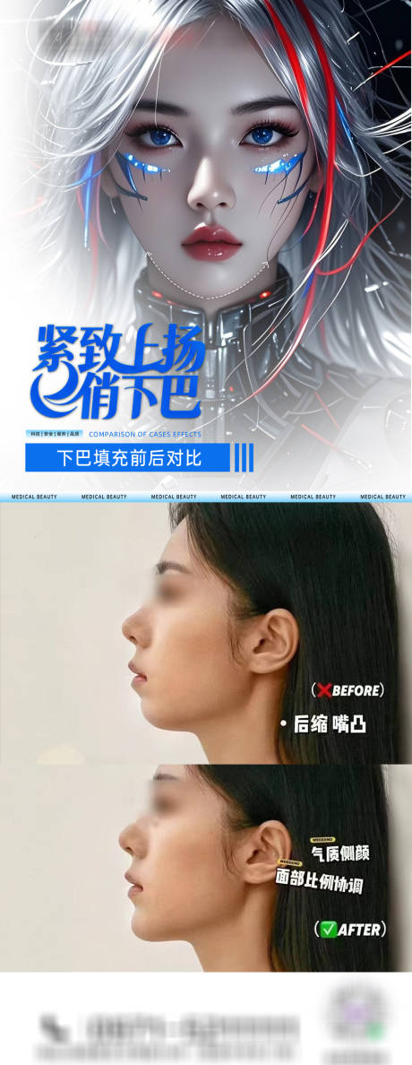源文件下载【医美下巴填充海报】编号：23290031080855769