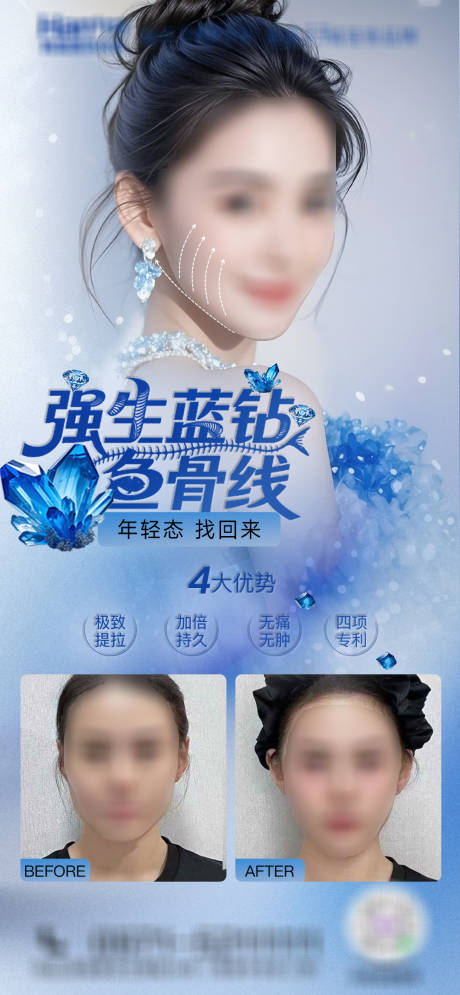 医美强生蓝钻鱼骨线