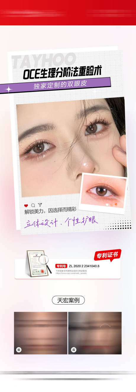 源文件下载【双眼皮重睑术系列图】编号：30980031084236825