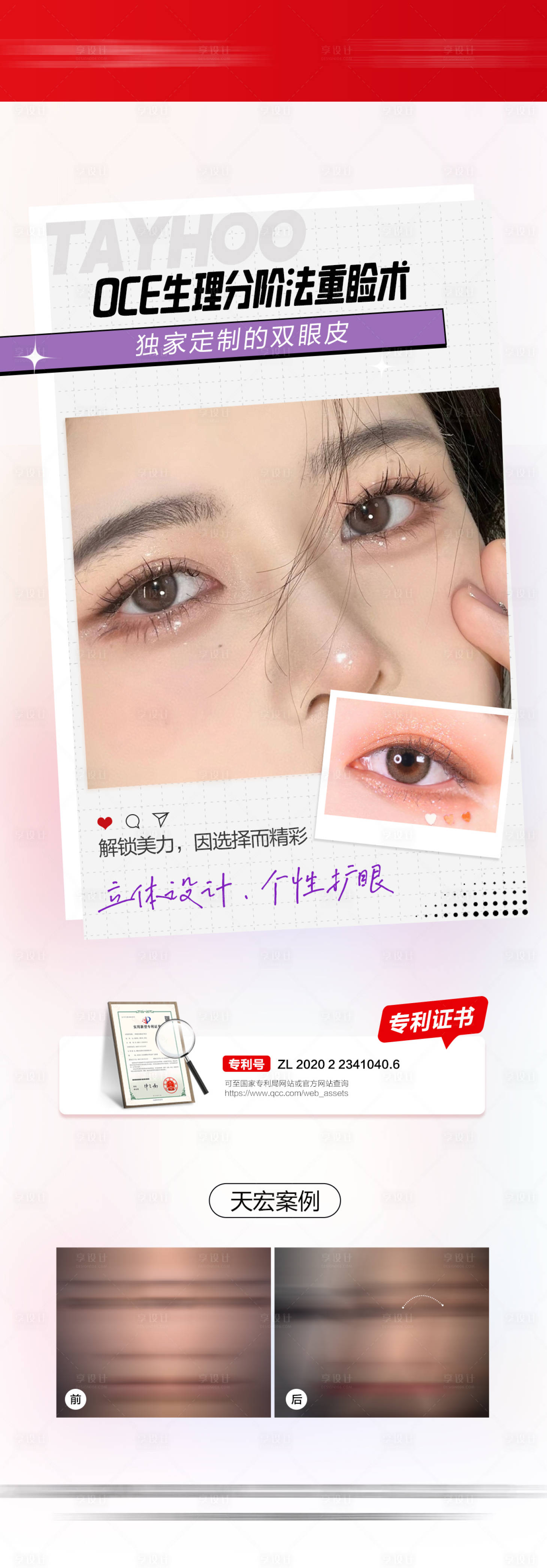 源文件下载【享设计】搜索编号：30980031084236825【双眼皮重睑术系列图】