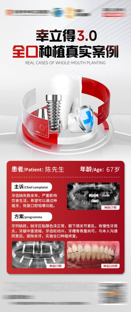 源文件下載【享設計】搜索編號：34930030520691622【全口種植真實案例海報】