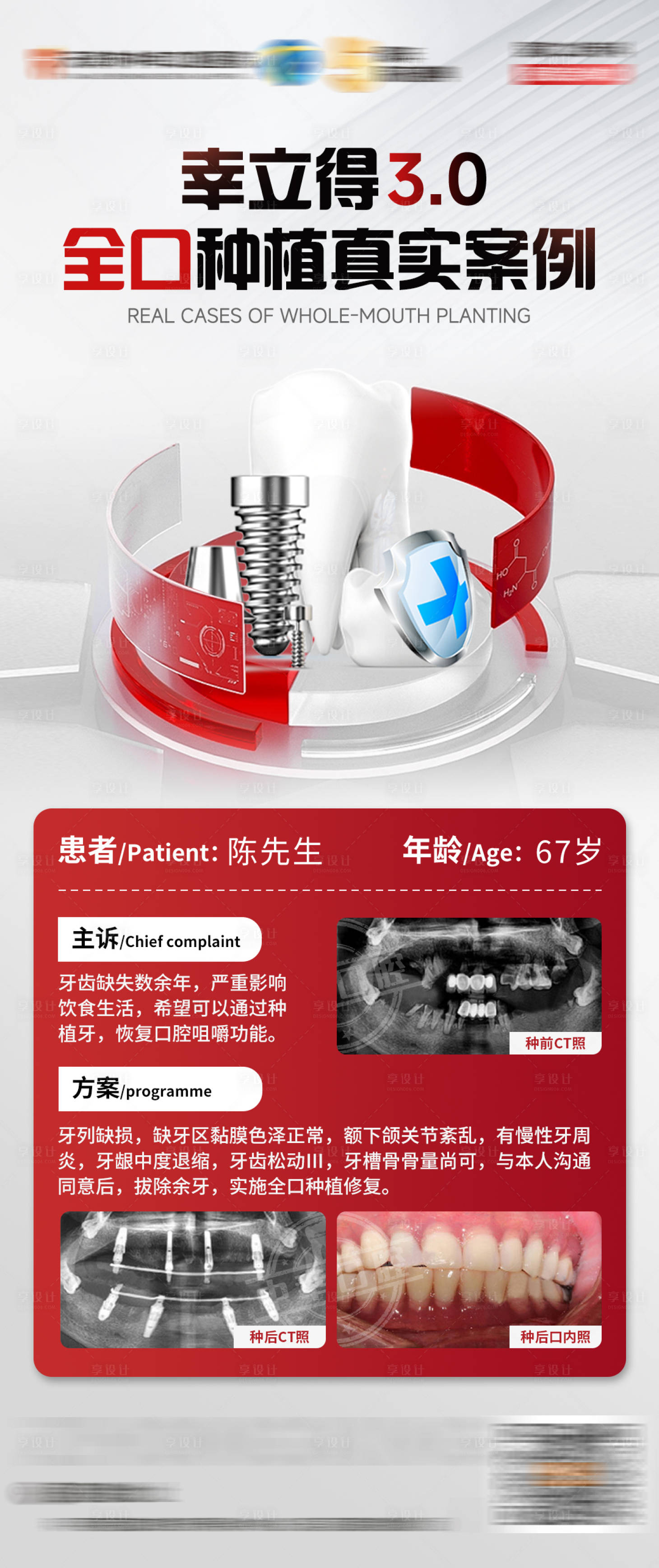 源文件下载【享设计】搜索编号：34930030520691622【全口种植真实案例海报】