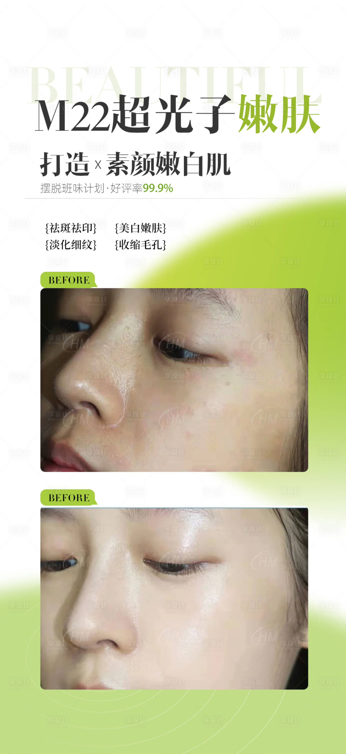 源文件下载【享设计】搜索编号：56180031271602946【光子嫩肤案例】
