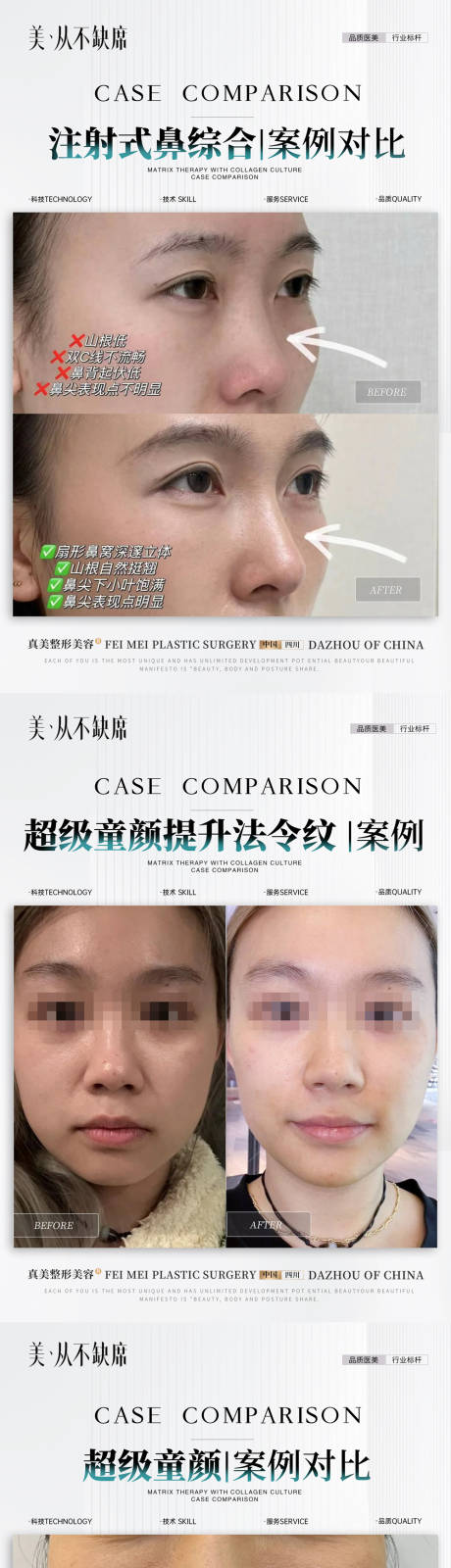 源文件下载【医美童颜隆鼻案例】编号：41360031628899877