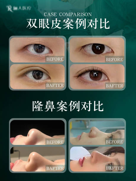 源文件下载【医美双眼皮隆鼻整形案例对比海报】编号：59240031446654176