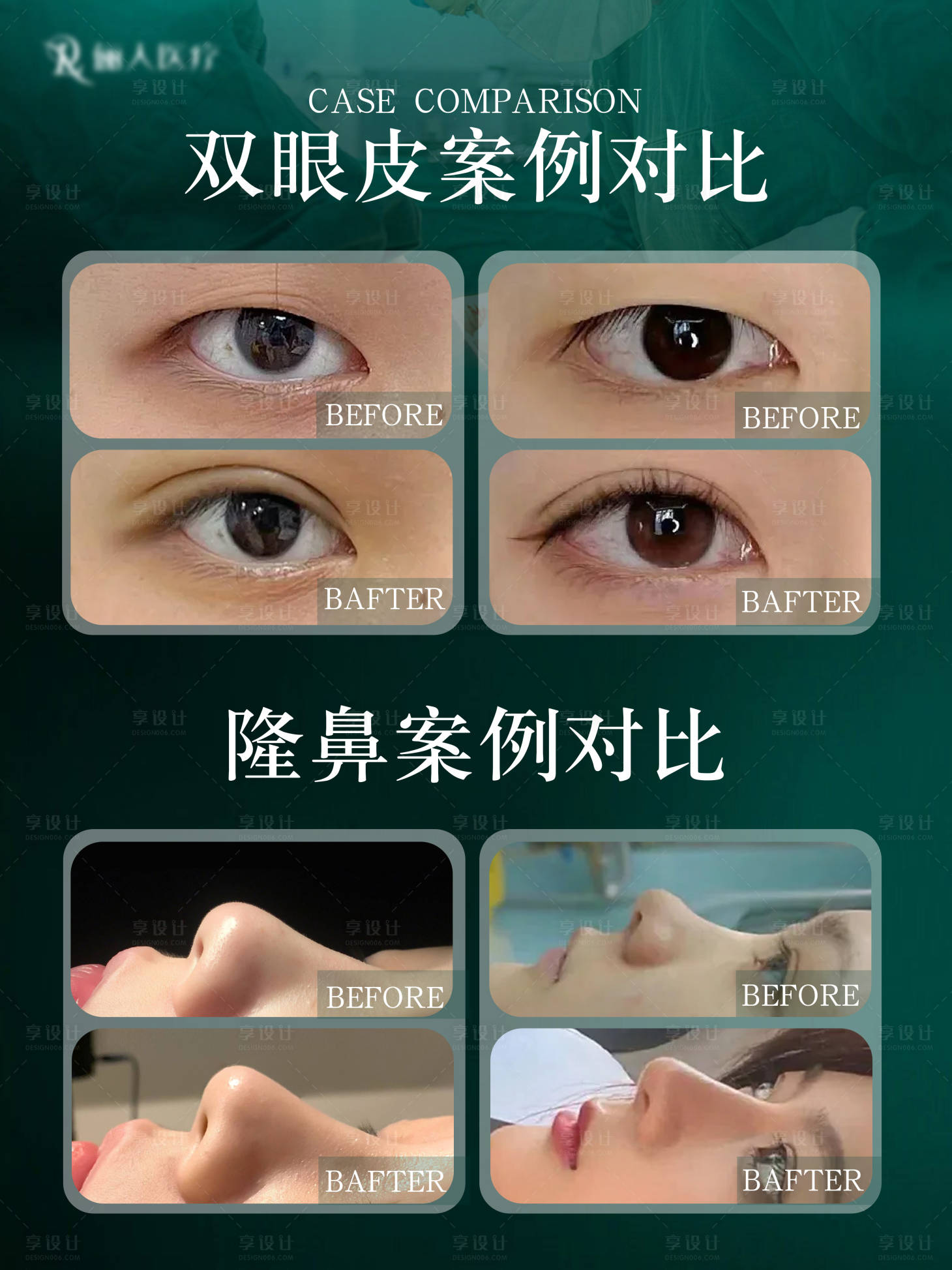 源文件下载【享设计】搜索编号：59240031446654176【医美双眼皮隆鼻整形案例对比海报】