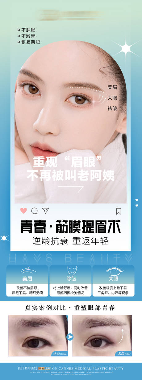 源文件下载【享设计】搜索编号：27000031632781302【医美整形筋膜提眉术科普案例海报】