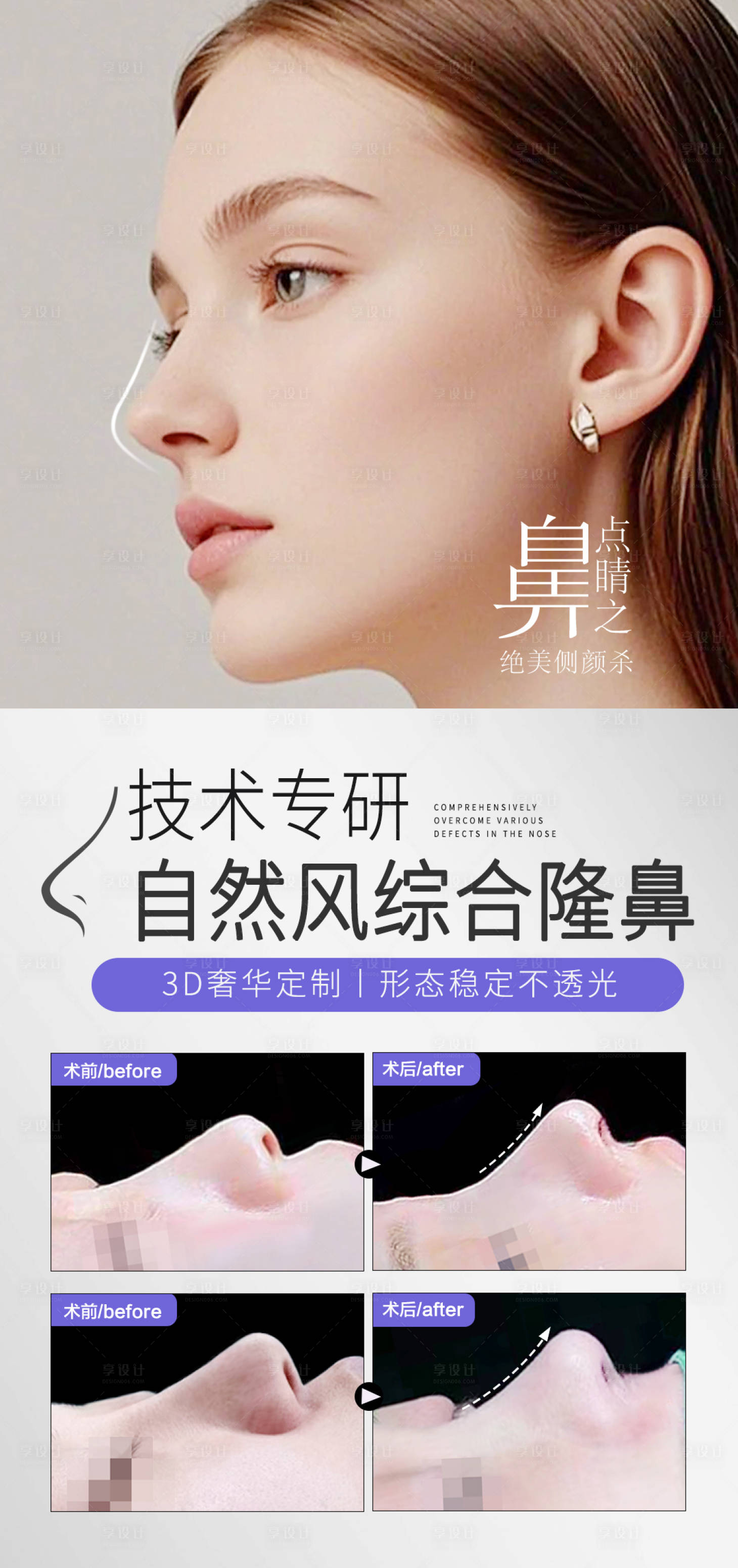 源文件下载【享设计】搜索编号：10690031384199829【隆鼻真人案例对比海报】