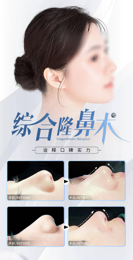 源文件下载【医美隆鼻案例海报】编号：85040031223531367