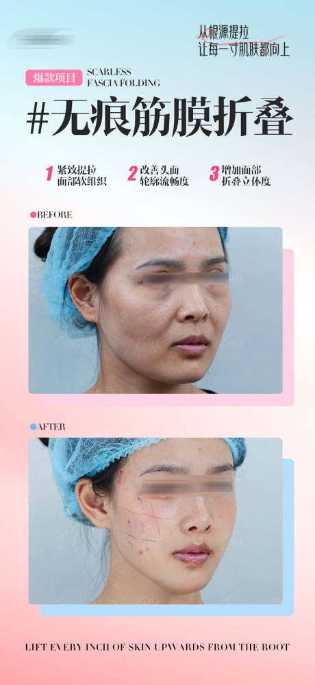 无痕筋膜折叠