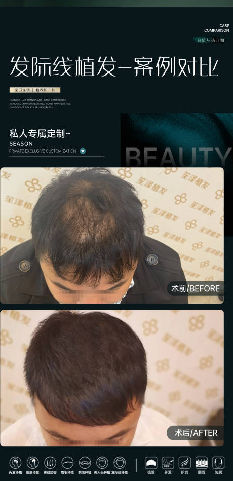 源文件下載【享設(shè)計(jì)】搜索編號(hào)：34560031401401901【醫(yī)美植發(fā)案例對(duì)比海報(bào)】