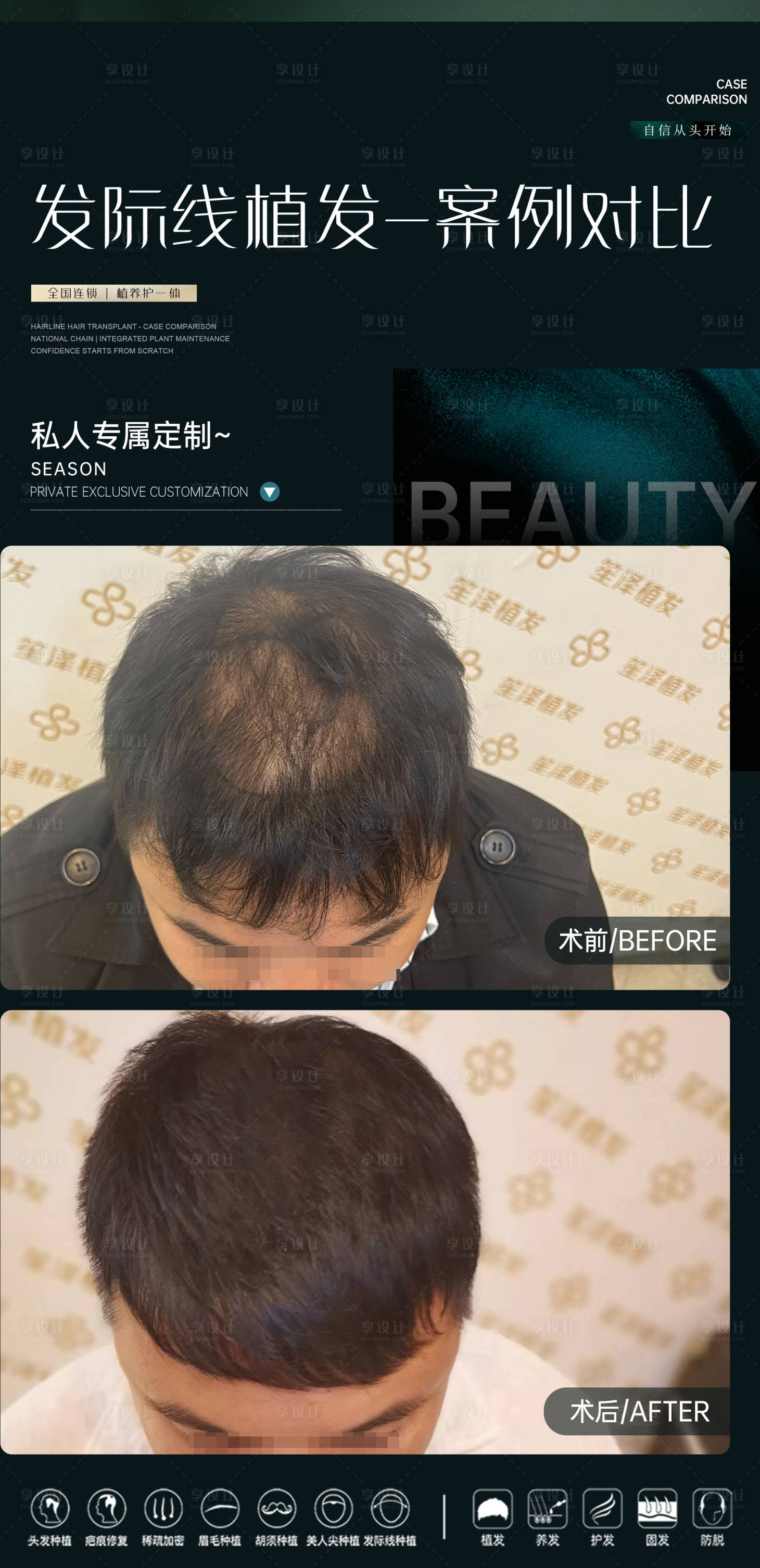 源文件下載【享設(shè)計(jì)】搜索編號(hào)：34560031401401901【醫(yī)美植發(fā)案例對(duì)比海報(bào)】